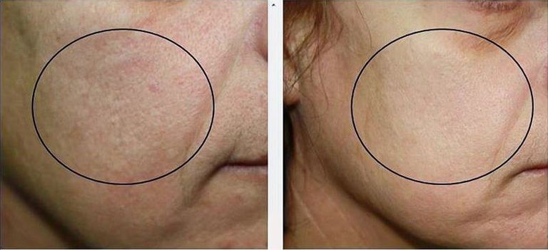 Pollogeon Ultrasound OTU-11 Код:null. Изображение 11